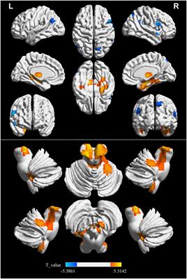 Spatiotemporal consistency analysis of cerebral small vessel disease: an rs-fMRI study